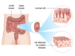 The difference between  healthy Villi and a Coeliac sufferers Villi